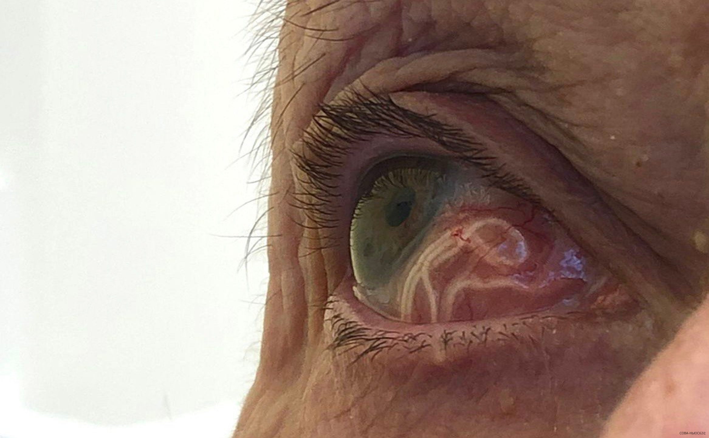 Рязанские врачи вынули из глаза пациентки червя